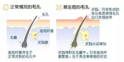 油皮男士如何战痘