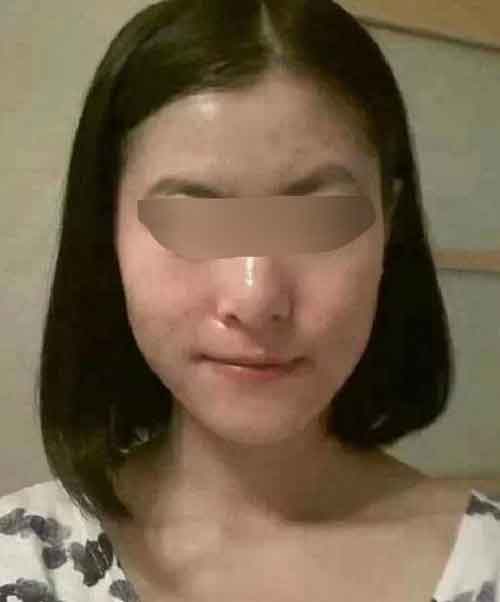 职场女性如何战胜顽固痘痘